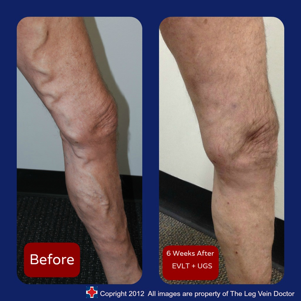 endovenous laser ablation of varicose veins